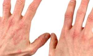 Виды дерматитов у детей и взрослых — причины возникновения и симптомы