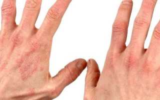 Виды дерматитов у детей и взрослых — причины возникновения и симптомы