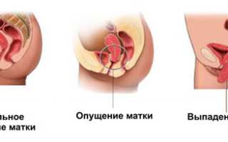 Как определить опущение матки по симптоматике и в ходе исследований?