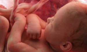 Замершая беременность