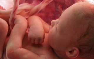 Замершая беременность