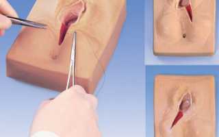 Зачем нужны швы после родов, возможные проблемы