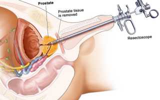 Тур синдром в урологии особенность анестезии