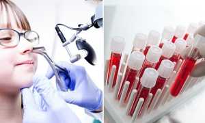 Хронический гайморит — симптомы и лечение в домашних условиях