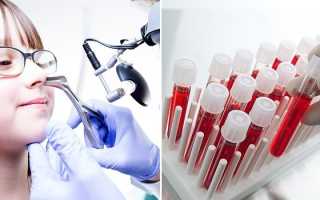 Хронический гайморит — симптомы и лечение в домашних условиях