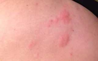 Признаки абсцесса после укола — общие и местные симптомы воспаления