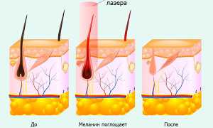 Лазерная эпиляция