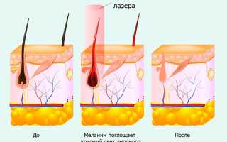 Лазерная эпиляция