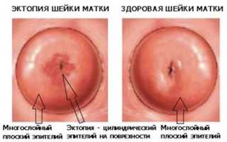 Симптомы, причины, диагностика и лечение врожденной эрозии шейки матки