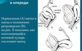 Как и почему развивается ретроверсия матки?