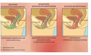 Кольпит — причины возникновения у женщин, симптомы и лечение