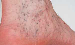 Диагностика вирусных гепатитов по внешним признакам	и составу крови