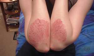 Эффективные способы лечения псориаза на руках