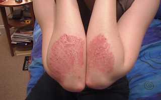 Эффективные способы лечения псориаза на руках