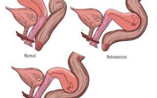 Что такое ретропозиция матки?
