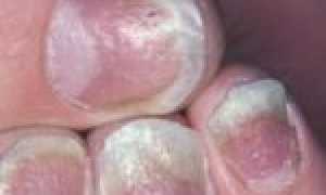 Способы лечения молочницы в домашних условиях