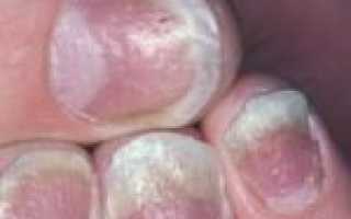 Способы лечения молочницы в домашних условиях