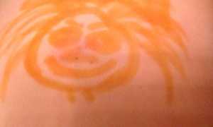 Лечение абсцесса после укола — эффективные медикаментозные и народные средства