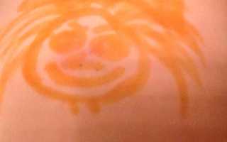 Лечение абсцесса после укола — эффективные медикаментозные и народные средства