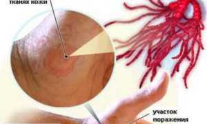 Пути заражения и меры предосторожности от стригущего лишая