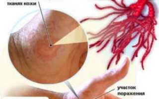 Пути заражения и меры предосторожности от стригущего лишая