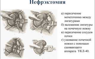 Какая группа инвалидности если нет почки