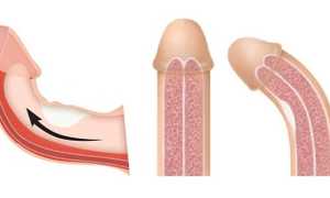 Болезнь Пейрони — симптомы, причины и признаки, диагностика, методы лечения, последствия