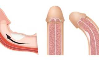 Болезнь Пейрони — симптомы, причины и признаки, диагностика, методы лечения, последствия