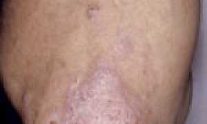 Хроническое поражение кожных покровов — псориаз на локтях