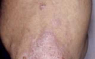 Хроническое поражение кожных покровов — псориаз на локтях