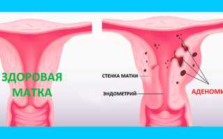 Аденомиоз матки: причины, симптомы и лечение