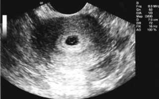 Пышный эндометрий: особенности и причины появления