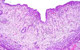 Какие особенности имеет миометрит?