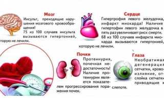Признаки гипертонического криза у женщин, лечение болезни