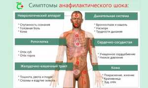 Анафилактический шок — причины возникновения, симптомы и лечение