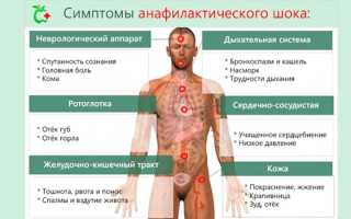 Анафилактический шок — причины возникновения, симптомы и лечение