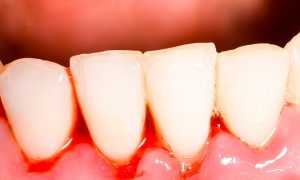 Эссенциальная тромбоцитемия — основные симптомы и причины заболевания, способы леения