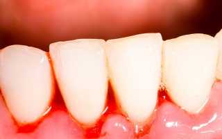 Эссенциальная тромбоцитемия — основные симптомы и причины заболевания, способы леения