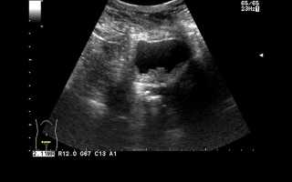 Можно ли увидеть рак эндометрия матки на УЗИ?