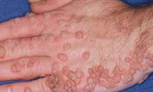 Вирус папилломы человека у мужчин