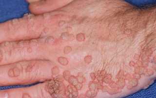 Вирус папилломы человека у мужчин