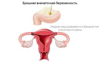 Брюшная внематочная беременность: клиническая картина, диагностика, методы лечения