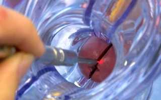 Как лечить лейкоплакию шейки матки: обзор недостатков и преимуществ наиболее востребованных методик