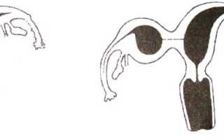 Однорогая матка: признаки и способы лечения