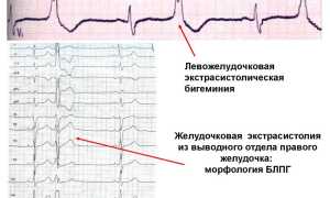 Желудочковая экстрасистолия: причины, симптомы, виды и лечение