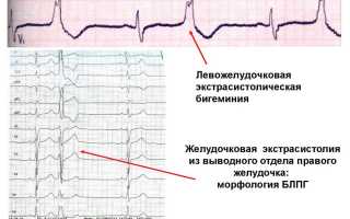 Желудочковая экстрасистолия: причины, симптомы, виды и лечение