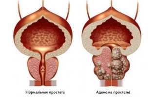 Доброкачественная опухоль — виды новообразований, симптомы и лечение