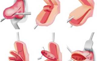 Пластика шейки матки: методы и целесообразность