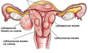 Миома матки и беременность