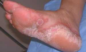 Все что нужно знать о грибке на ступнях